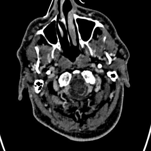 Cerebral arteriovenous malformation (Radiopaedia 78188-90746 Axial C+ delayed 10).jpg