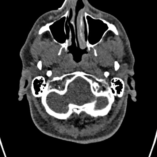 Cerebral arteriovenous malformation (Radiopaedia 78188-90746 Axial non-contrast 18).jpg
