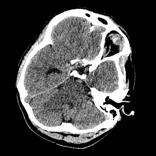 Cerebral arteriovenous malformation (Radiopaedia 79677-92887 Axial non-contrast 8).jpg