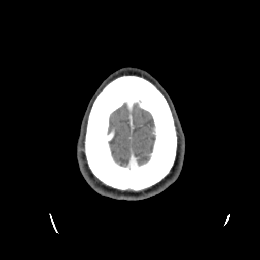 Cerebral arteriovenous malformation (Spetzler-Martin grade 2) (Radiopaedia 41262-44076 Axial C+ 48).png
