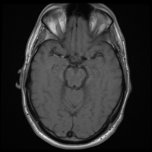 File:Cerebral arteriovenous malformation (Spetzler-Martin grade 2) (Radiopaedia 41262-44092 Axial T1 7).png