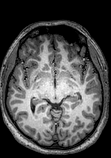 Cerebral arteriovenous malformation at posterior body of corpus callosum (Radiopaedia 74111-84925 Axial T1 169).jpg