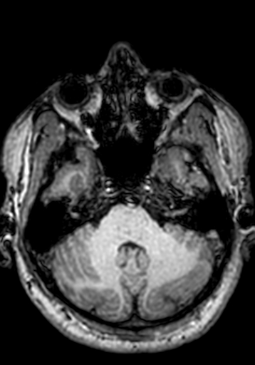Cerebral arteriovenous malformation at posterior body of corpus callosum (Radiopaedia 74111-84925 Axial T1 240).jpg