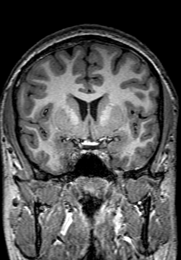 Cerebral arteriovenous malformation at posterior body of corpus callosum (Radiopaedia 74111-84925 Coronal T1 126).jpg
