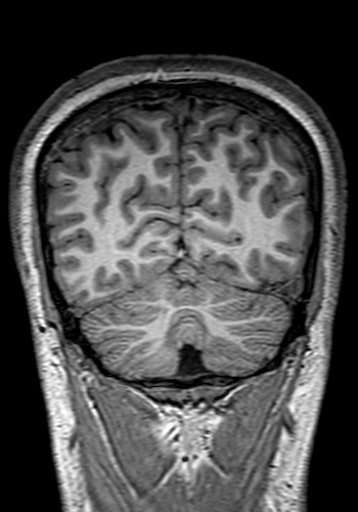 Cerebral arteriovenous malformation at posterior body of corpus callosum (Radiopaedia 74111-84925 Coronal T1 282).jpg