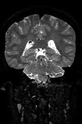 Cerebral arteriovenous malformation at posterior body of corpus callosum (Radiopaedia 74111-84925 Coronal T2 113).jpg