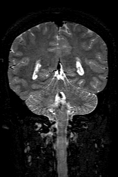 Cerebral arteriovenous malformation at posterior body of corpus callosum (Radiopaedia 74111-84925 Coronal T2 122).jpg