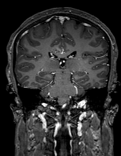 Cerebral arteriovenous malformation at posterior body of corpus callosum (Radiopaedia 74111-84925 K 220).jpg