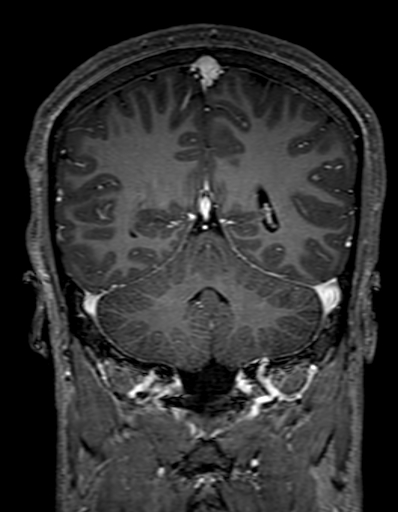 Cerebral arteriovenous malformation at posterior body of corpus callosum (Radiopaedia 74111-84925 K 261).jpg