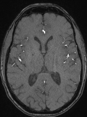 Cerebral arteriovenous malformation with hemorrhage (Radiopaedia 34422-35737 Axial MRA 44).png