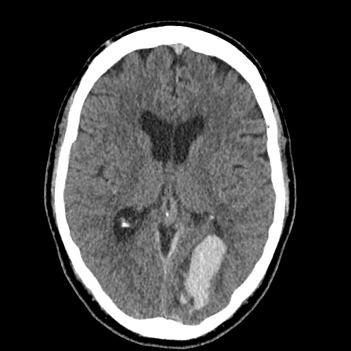 Cerebral arteriovenous malformation with lobar hemorrhage (Radiopaedia 35598-37117 Axial non-contrast 28).jpg