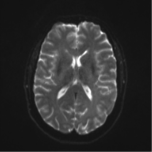 File:Cerebral cavernoma and development venous anomaly (Radiopaedia 37603-39482 Axial DWI 13).png