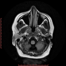 File:Cerebral cavernous malformation (Radiopaedia 26177-26306 FLAIR 4).jpg