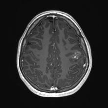 Cerebral cavernous venous malformation (Radiopaedia 70008-80021 Axial T1 C+ 69).jpg
