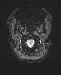 Cerebral cavernous venous malformation (Radiopaedia 70008-80021 I 1).jpg