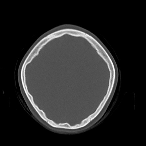 Cerebral cavernous venous malformation (Radiopaedia 70008-80022 Axial bone window 40).jpg