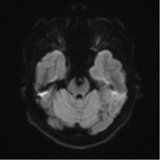 Cerebral cavernous venous malformations (Radiopaedia 48117-52946 Axial DWI 36).png