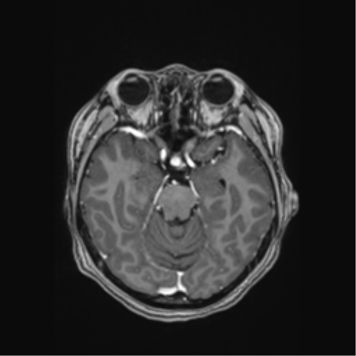 Cerebral cavernous venous malformations (Radiopaedia 48117-52946 Axial T1 C+ 19).png