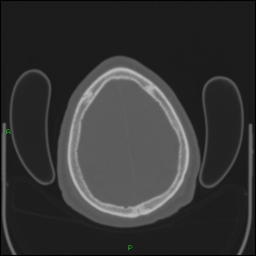 File:Cerebral contusions (Radiopaedia 33868-35039 Axial bone window 188).jpg
