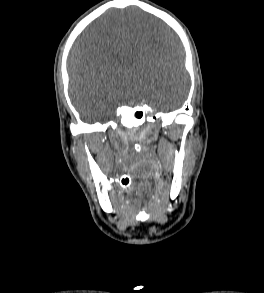 Cerebral edema in an overdose patient (Radiopaedia 72005-82539 B 31).jpg