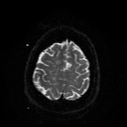 Cerebral embolic infarcts (embolic shower) (Radiopaedia 49837-55108 Axial DWI 8).jpg