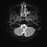 File:Cerebral embolic infarcts (embolic shower) (Radiopaedia 72391-82921 Axial DWI 3).jpg