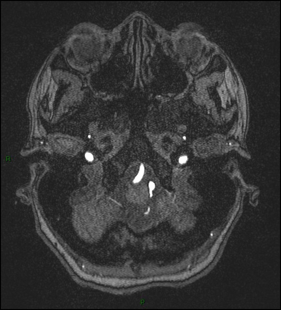 Cerebral fat embolism (Radiopaedia 35022-36525 Axial TOF 21).jpg