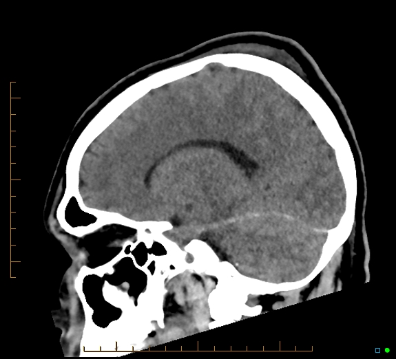 Cerebral fat embolism (Radiopaedia 85521-101224 C 21).jpg