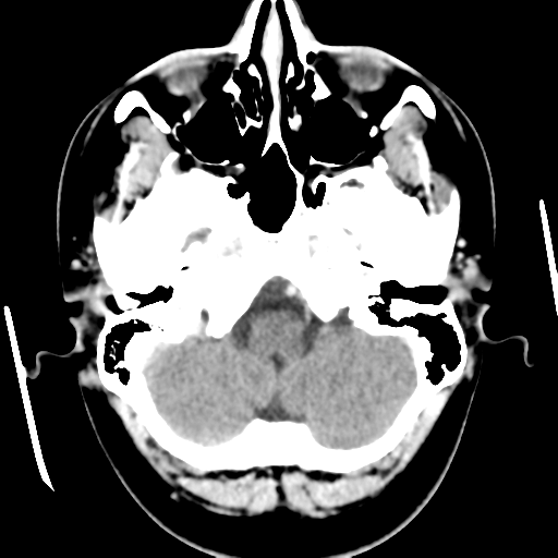 Cerebral hemorrhage secondary to arteriovenous malformation (Radiopaedia 33497-34561 B 11).png