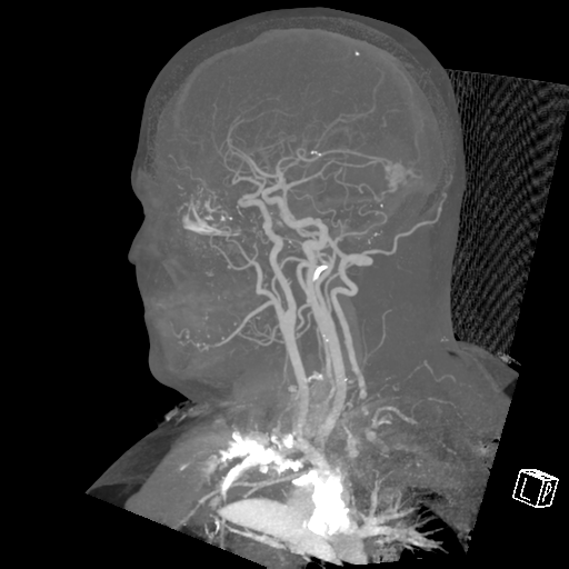 File:Cerebral hemorrhage secondary to arteriovenous malformation (Radiopaedia 33497-34571 A 8).png