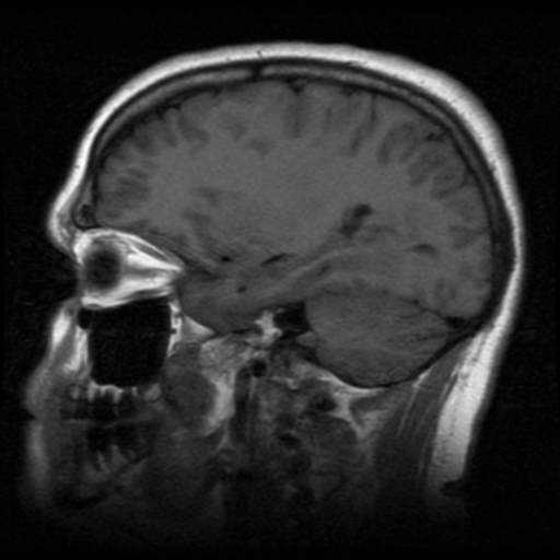 File:Cerebral hemorrhage secondary to arteriovenous malformation (Radiopaedia 33497-34572 Sagittal T1 15).png