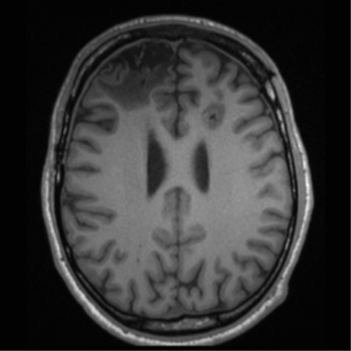 File:Cerebral hemorrhagic contusions- temporal evolution (Radiopaedia 40224-42757 Axial T1 50).png