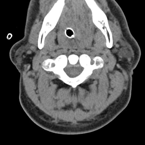 Cerebral hemorrhagic contusions and cervical spine fractures (Radiopaedia 32865-33841 F 14).jpg
