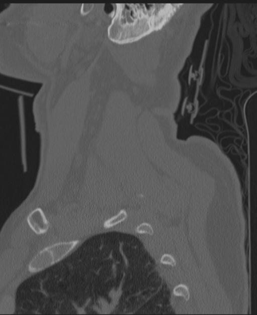 Cerebral hemorrhagic contusions and cervical spine fractures (Radiopaedia 32865-33841 Sagittal bone window 13).jpg