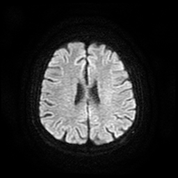 Cerebral metastases - melanoma (Radiopaedia 80972-94522 Axial DWI 52).jpg