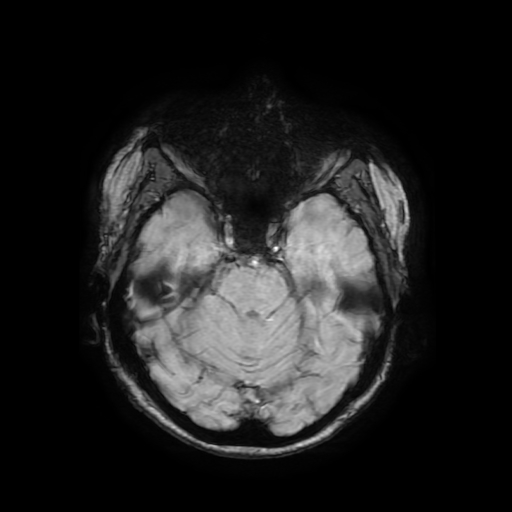 Cerebral metastases - melanoma (Radiopaedia 80972-94522 Axial SWI 32).jpg