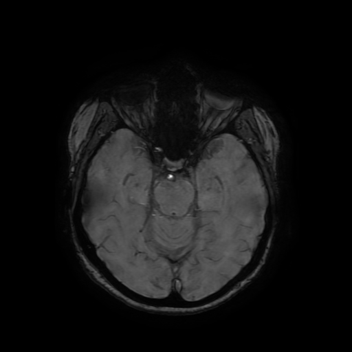 Cerebral metastases - melanoma (Radiopaedia 80972-94522 Axial SWI 37).jpg