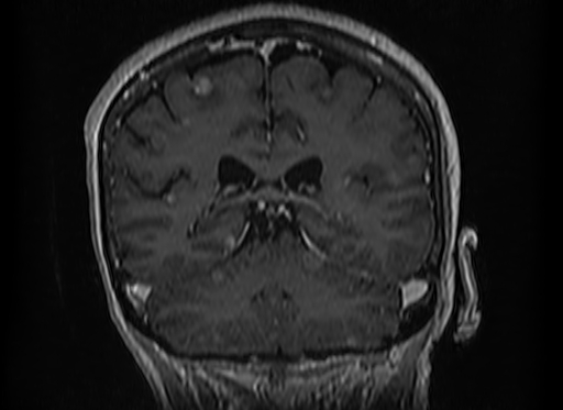 Cerebral metastases from lung cancer with amyloid angiopathy and cerebellopontine angle meningioma (Radiopaedia 74306-85191 Coronal T1 C+ 40).jpg