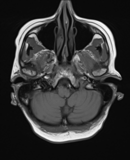 File:Cerebral metastasis (Radiopaedia 46744-51248 Axial T1 4).png