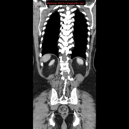 File:Cerebral metastasis - colorectal carcinoma (Radiopaedia 8581-83548 A 67).jpg