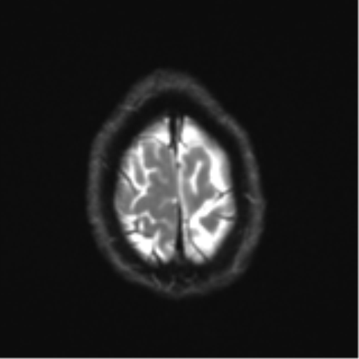 Cerebral metastasis - melanoma (Radiopaedia 54718-60954 Axial DWI 27).png