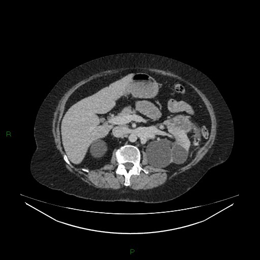 Cerebral metastasis from renal cell carcinoma (Radiopaedia 82306-96378 A 63).jpg