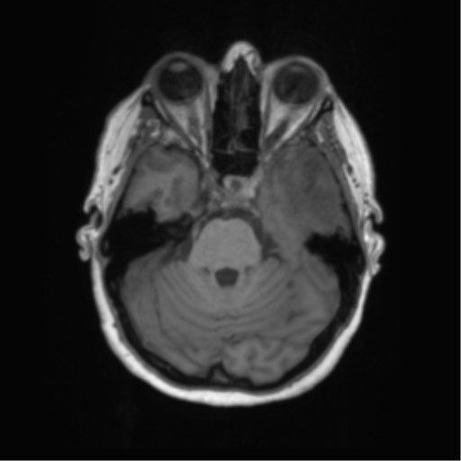 Cerebral metastasis mimicking glioblastoma (Radiopaedia 69155-78937 Axial T1 16).png