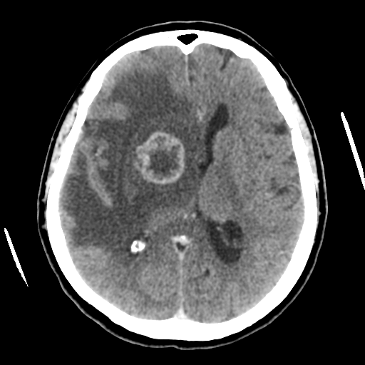 Cerebral metastasis to basal ganglia (Radiopaedia 81568-95412 Axial C+ delayed 32).png