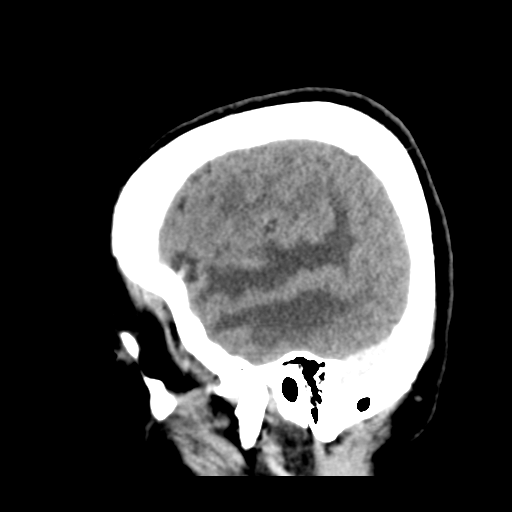 Cerebral metastasis to basal ganglia (Radiopaedia 81568-95412 Sagittal C+ delayed 12).png