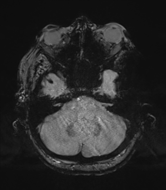 Cerebral metastasis to basal ganglia (Radiopaedia 81568-95413 Axial SWI magnitude 17).png
