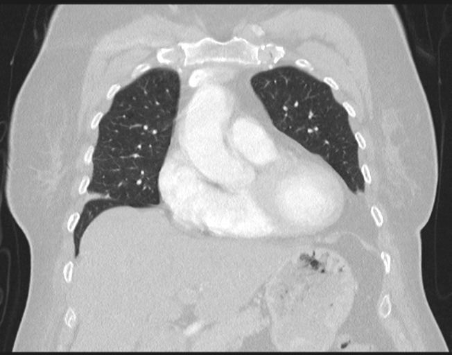 File:Cerebral metastasis to basal ganglia (Radiopaedia 81568-95414 Coronal lung window 30).png