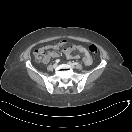 File:Cerebral metastasis to basal ganglia (Radiopaedia 81568-95414 E 53).png