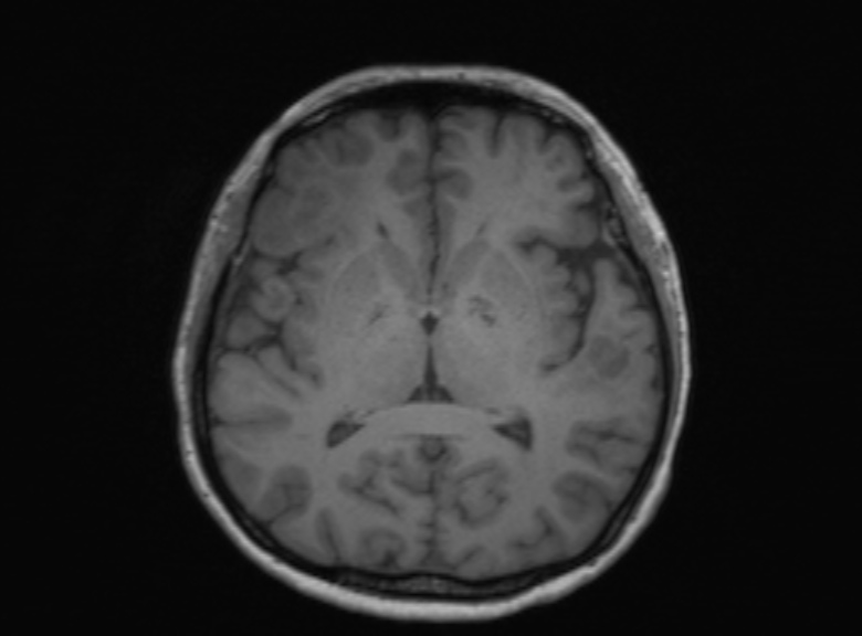 Cerebral ring enhancing lesions - cerebral metastases (Radiopaedia 44922-48817 Axial T1 225).jpg
