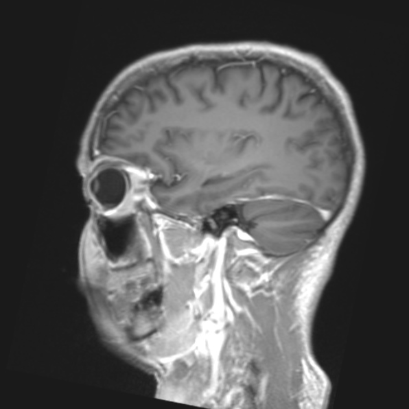 File:Cerebral toxoplasmosis (Radiopaedia 53993-61435 Coronal T1 11).jpg